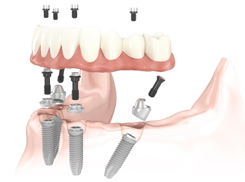 I vantaggi offerti dagli impianti all on four per ripristinare la tua dentatura